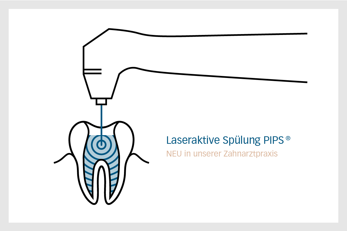 PIPS – Laseraktivierte Spülung PIPS in der modernen Endodontie